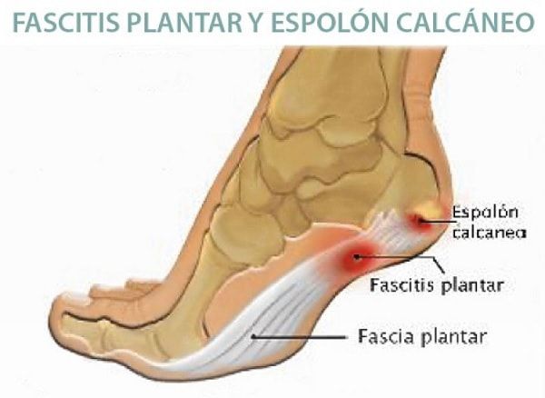 Fascitis Plantar y Espolon Calcaneo