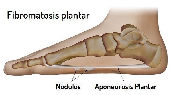 fibromatosis plantar