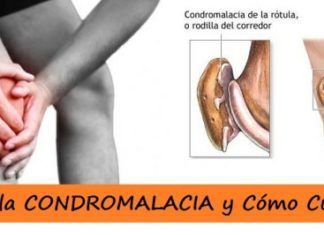 CONDROMALACIA rotuliana 【Ejercicios】 para evitar dolor de rodilla