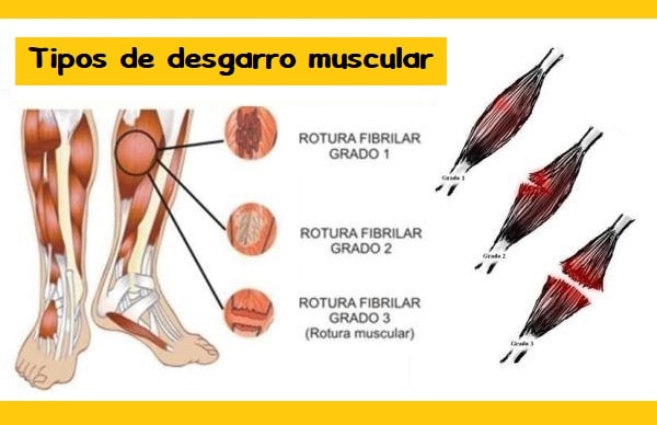 Rotura de fibras o desgarro muscular. Tratamiento, ejercicios y recuperación