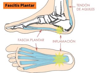 FASCITIS Plantar 【Síntomas, Tratamiento y Ejercicios】 Como Curar Fascitis Plantar