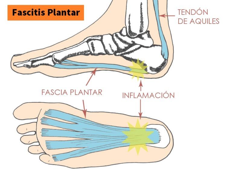 FASCITIS Plantar 【Síntomas, Tratamiento y Ejercicios】